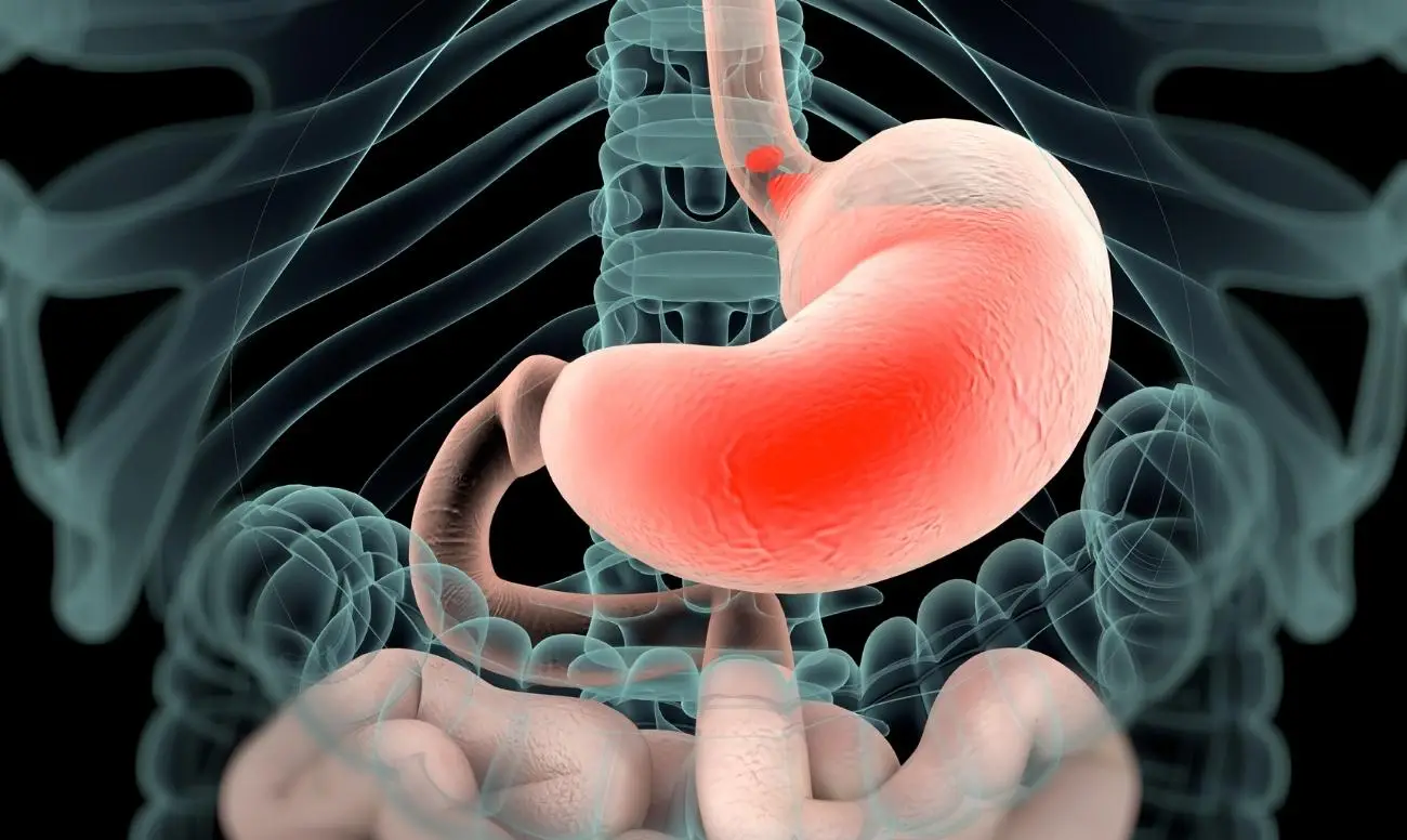 Virus dello stomaco: consigli pratici per prevenirlo e perché colpisce così tante persone